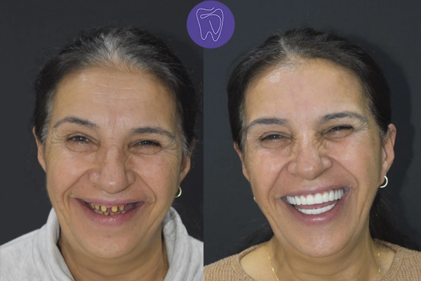 Before After Dental Treatment Antalya Gallery 