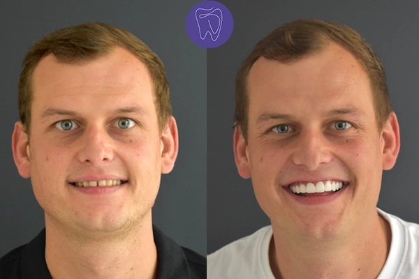 Before After Dental Treatment Antalya Gallery 