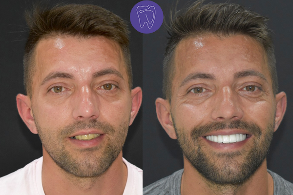 Before After Dental Treatment Antalya Gallery 