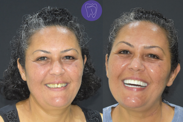 Before After Dental Treatment Antalya Gallery 