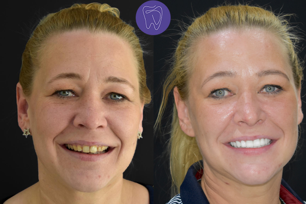 Before After Dental Treatment Antalya Gallery 