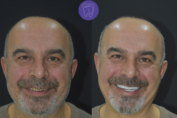 Before After Dental Treatment Antalya Gallery 