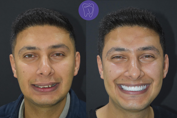 Before After Dental Treatment Antalya Gallery 