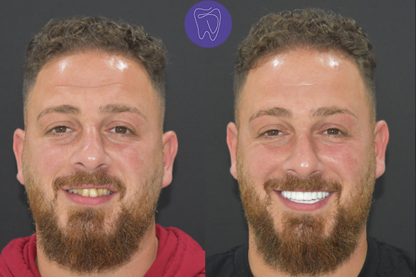 Before After Dental Treatment Antalya Gallery 