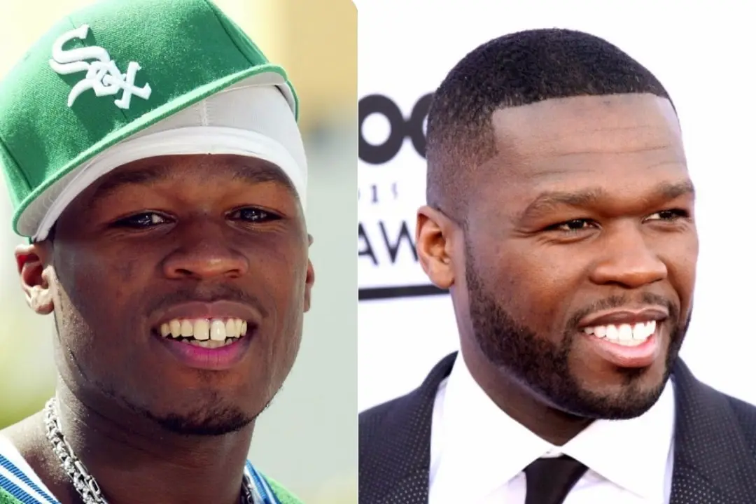 50 Cent dental implant before after