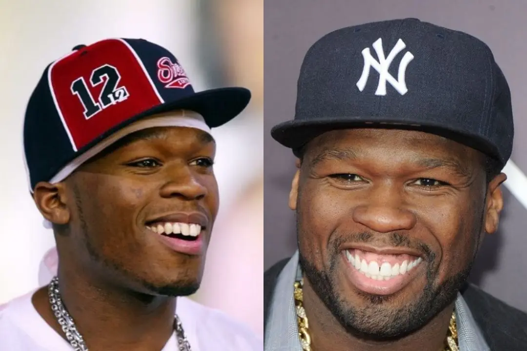 50 Cent dental implant before after