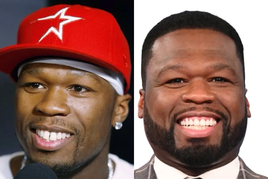 50 Cent dental implant before after