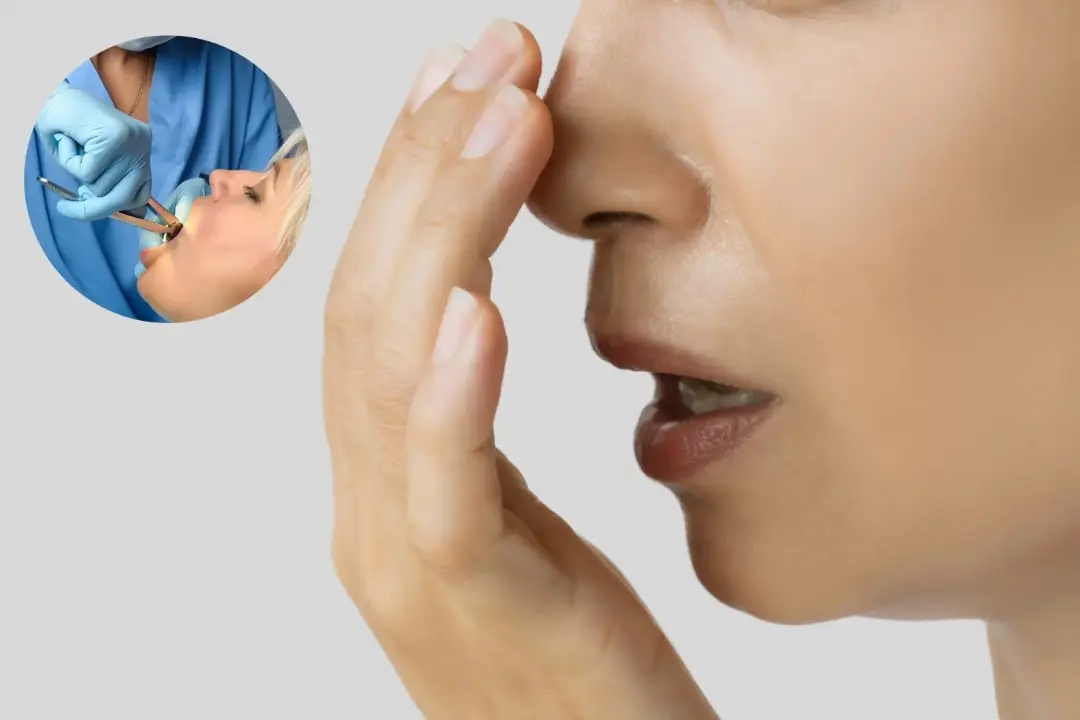 Bad breath after tooth extraction