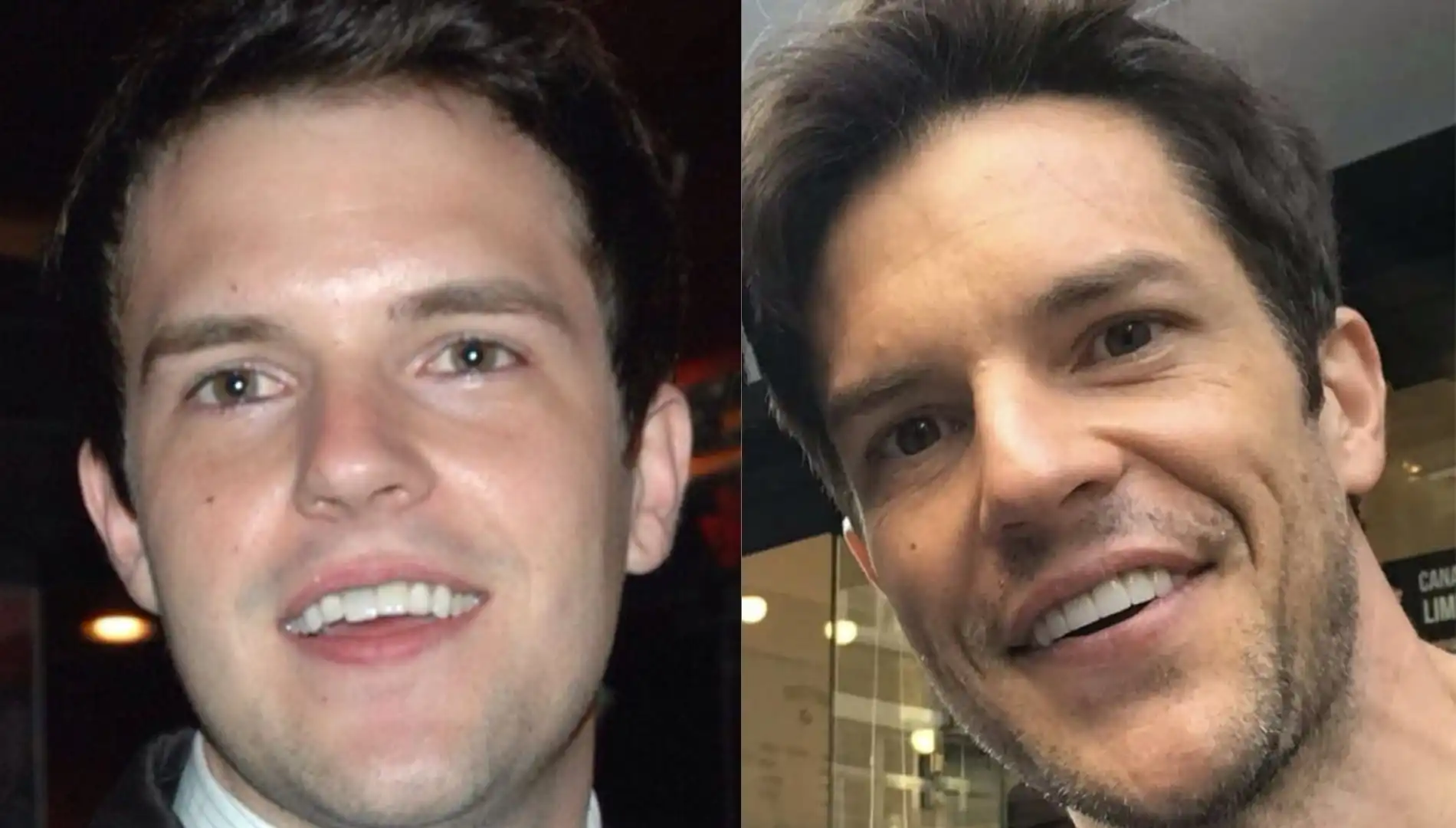 Brandon Flowers teeth before and after