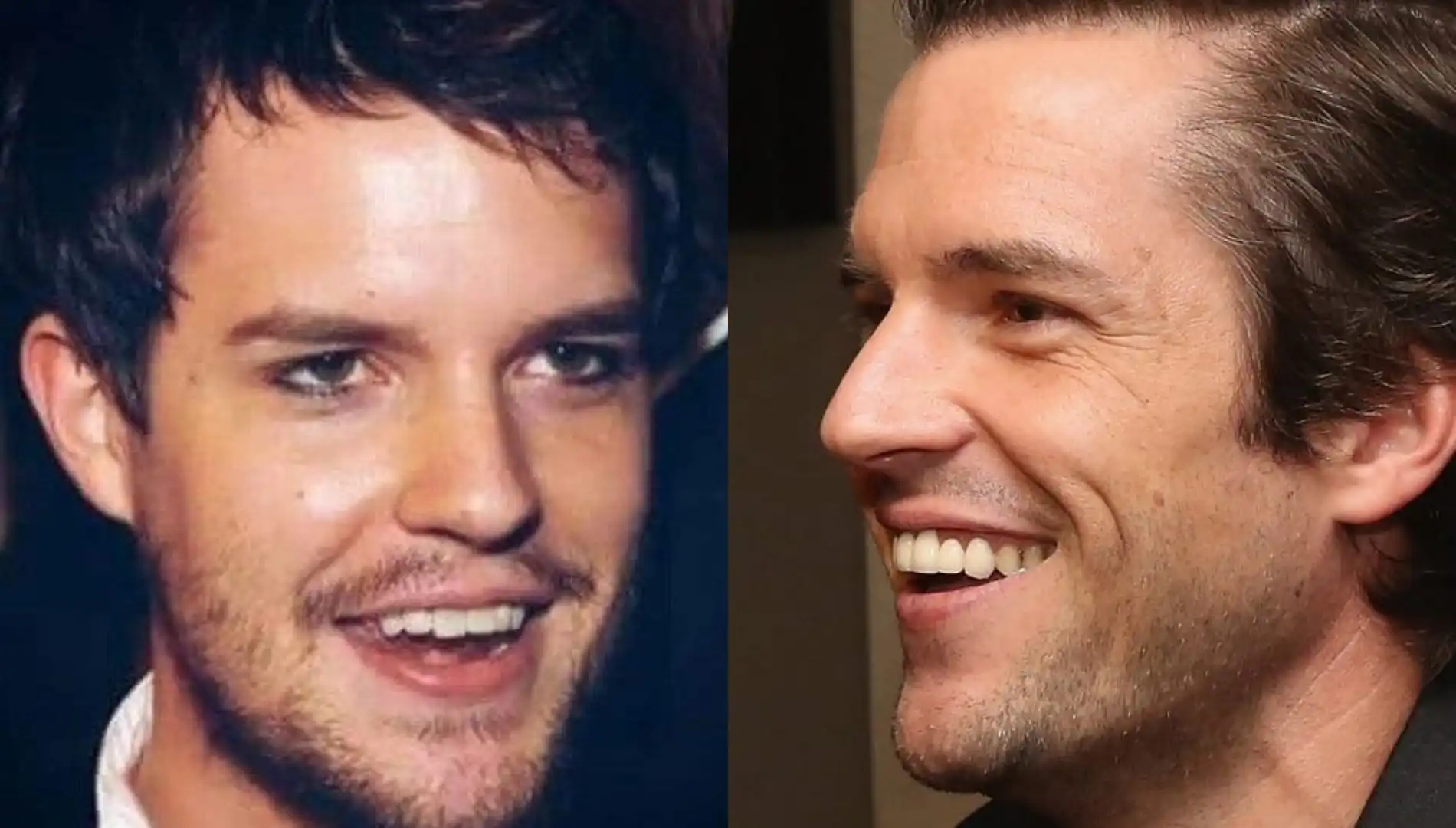 Brandon Flowers teeth before and after