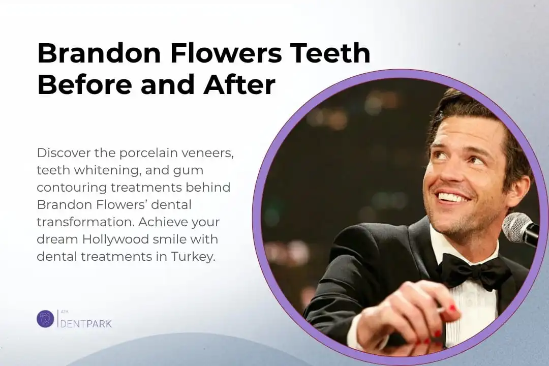 Brandon Flowers Teeth Before After
