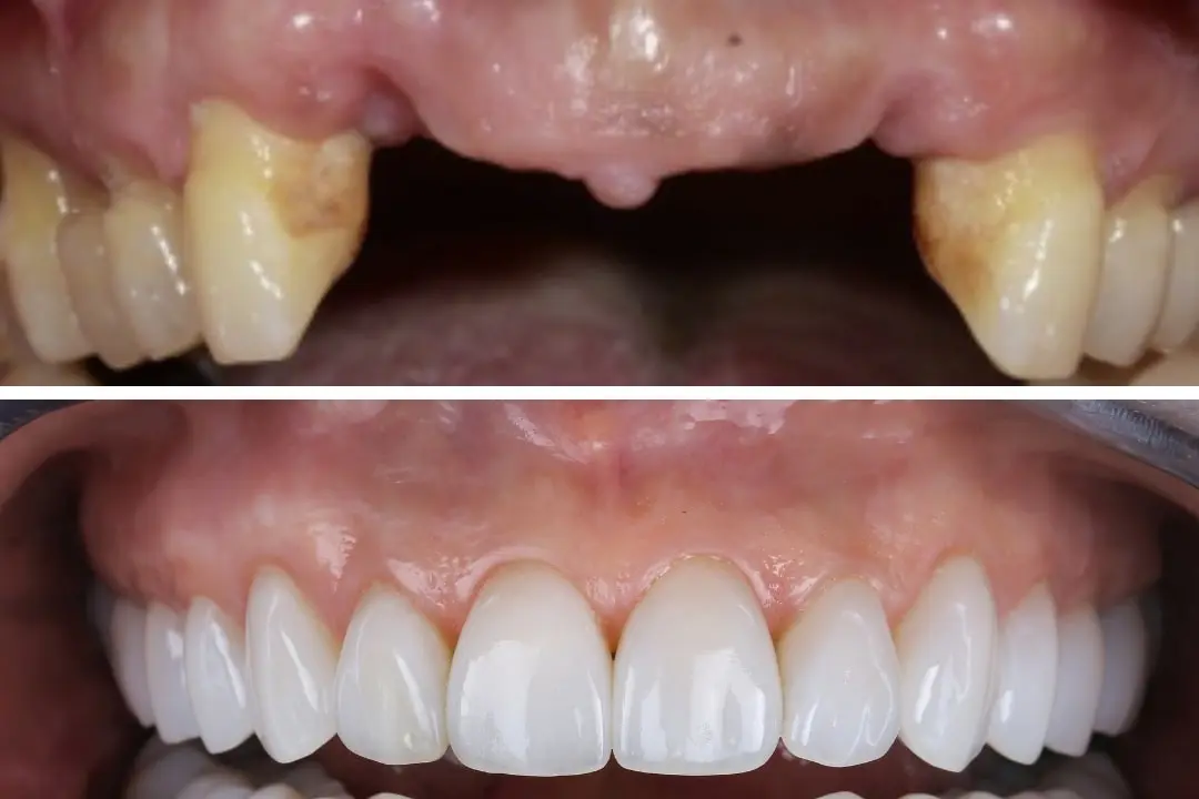 Can You Get Dental Implants with Periodontal Disease?