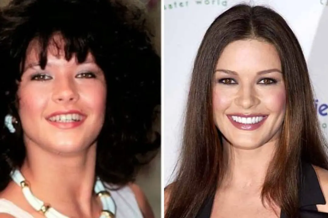 Catherine Zeta-Jones teeth before after