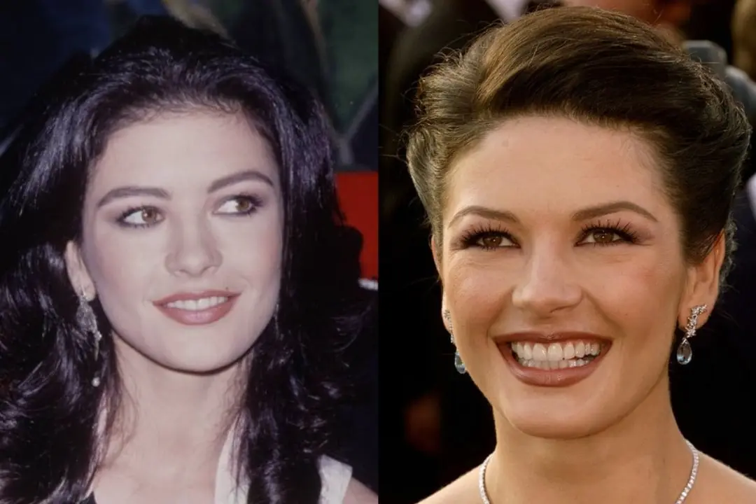 Catherine Zeta-Jones teeth implant before after