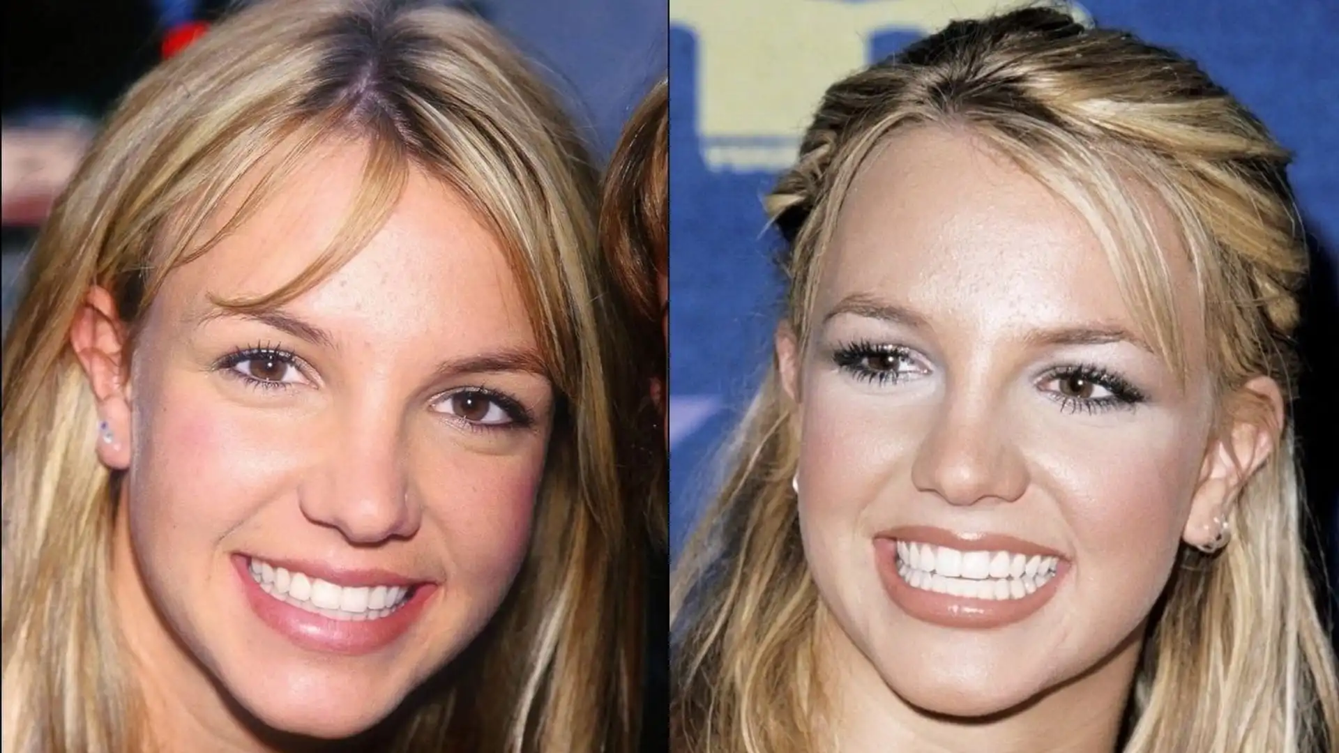 Britney Spears teeth veneer