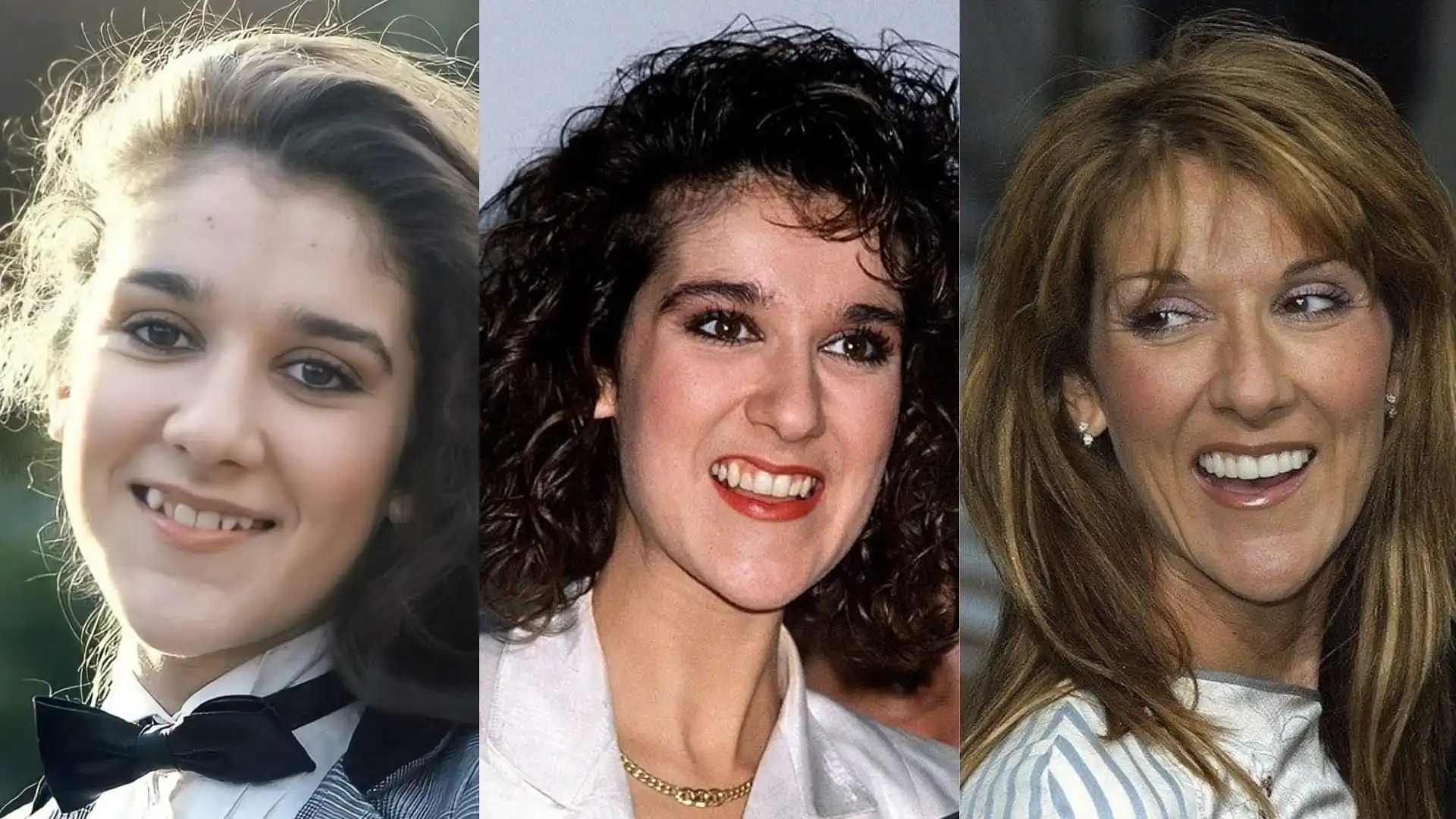 Celine Dion teeth veneer
