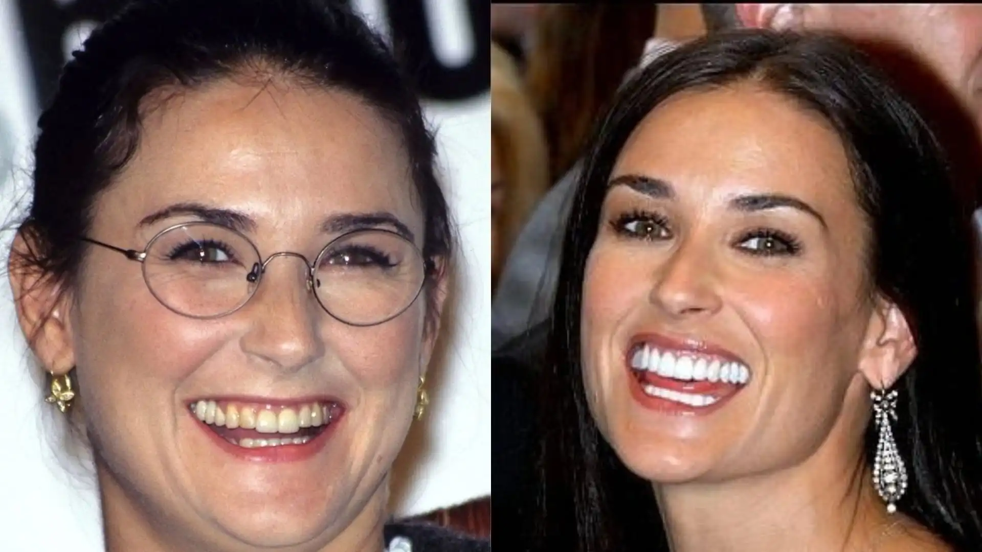 Demi Moore teeth veneer