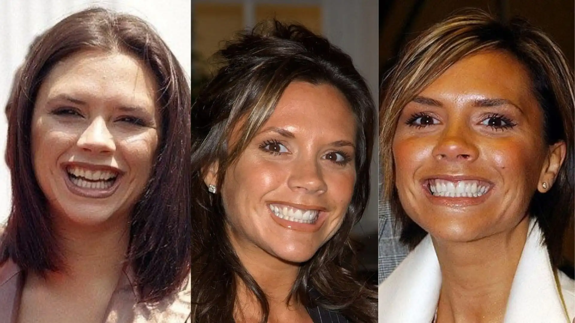 Victoria Beckham teeth veneer