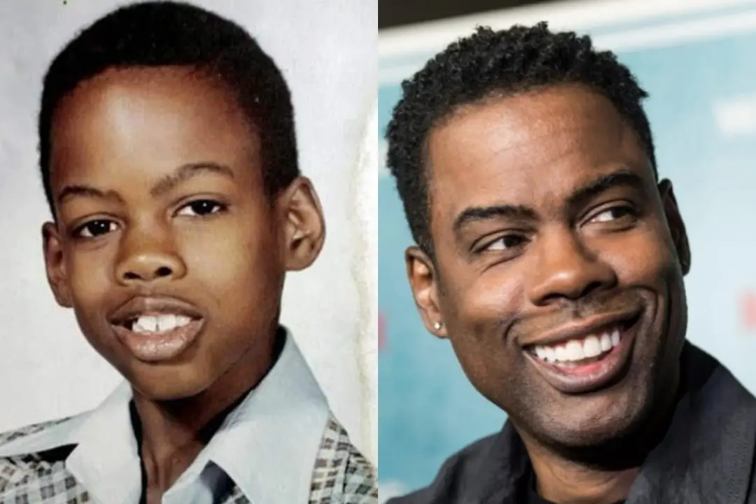 Chris Rock dental implant before after
