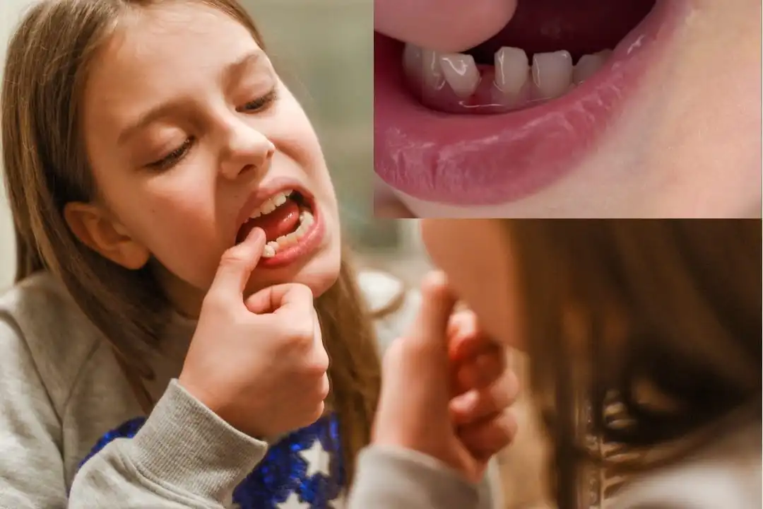 Common causes of loose teeth