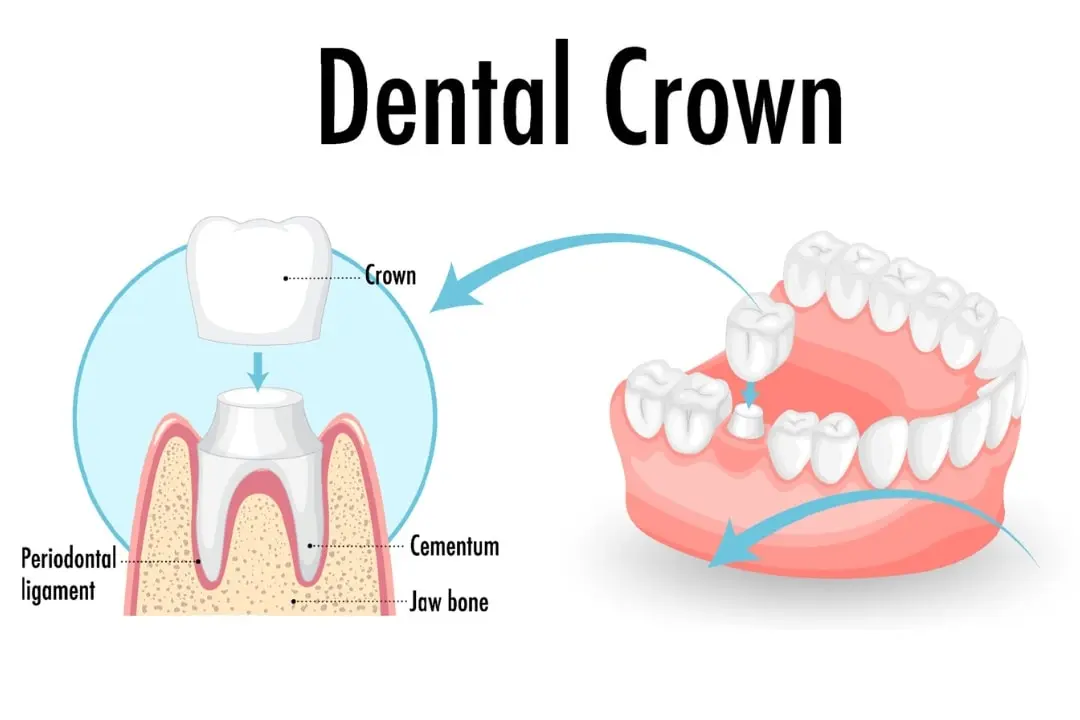 Dental crown in Turkey