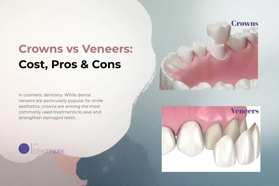 Crowns vs Veneers: Cost, Pros & Cons