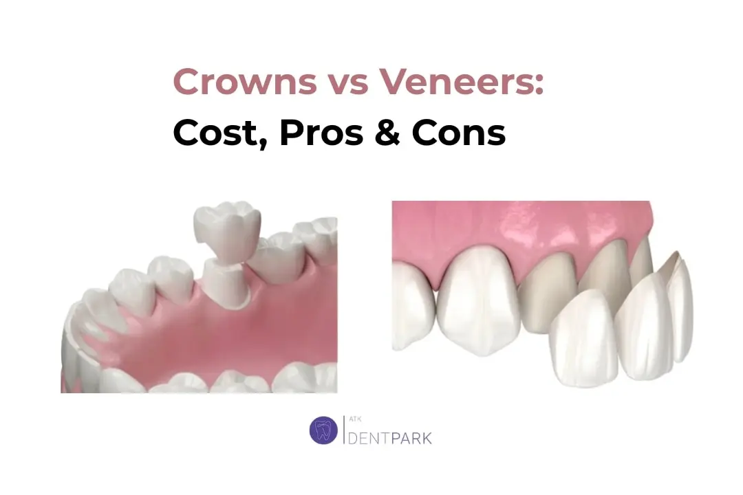 Dental Crowns vs. Veneers