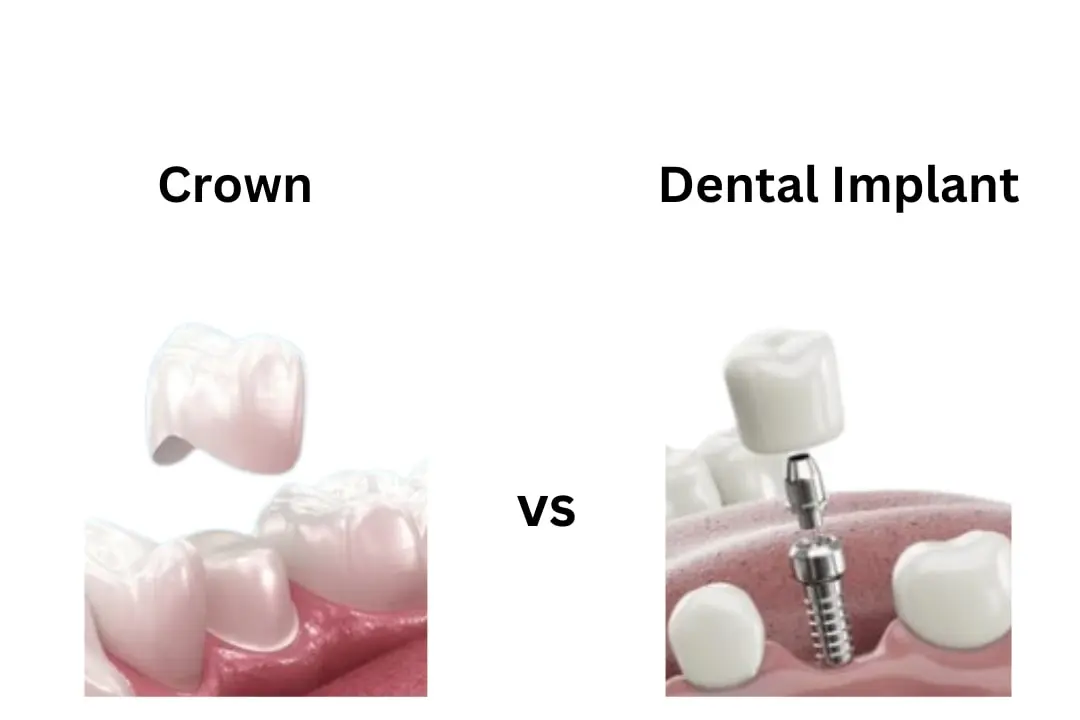 Crown vs Implant: Which option suitable for me?