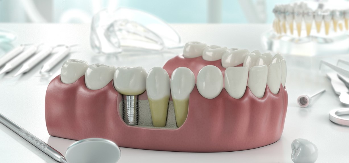 Dental Implant Antalya Turkey