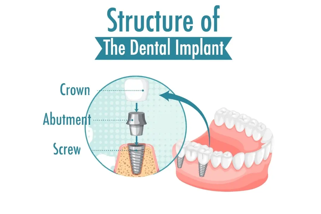 Dental implant in Antalya Turkey