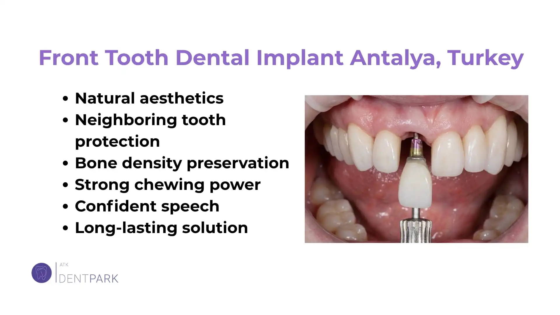 Front Tooth Dental Implant Antalya, Turkey
