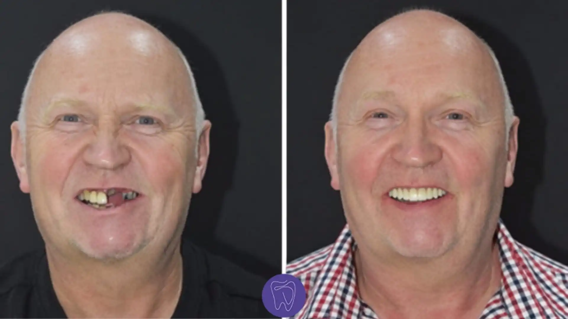 Benefits of front tooth implant
