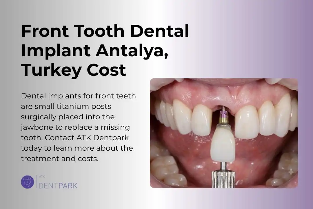 Front Tooth Dental Implant Antalya, Turkey Cost
