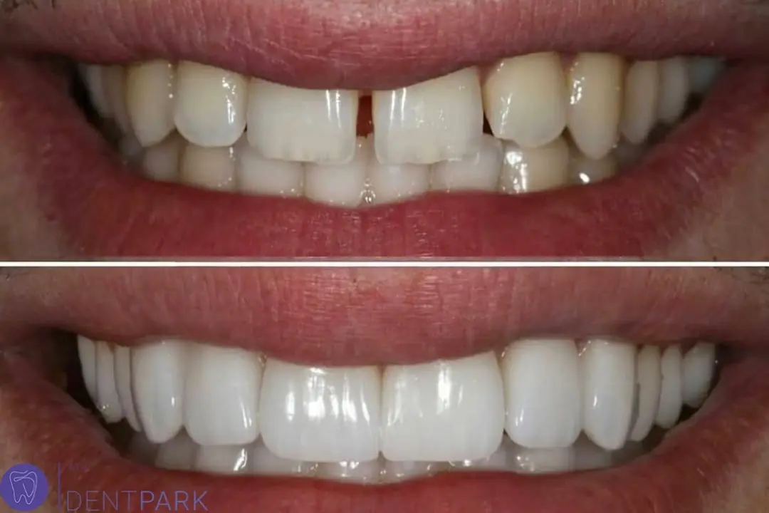 Gappy teeth