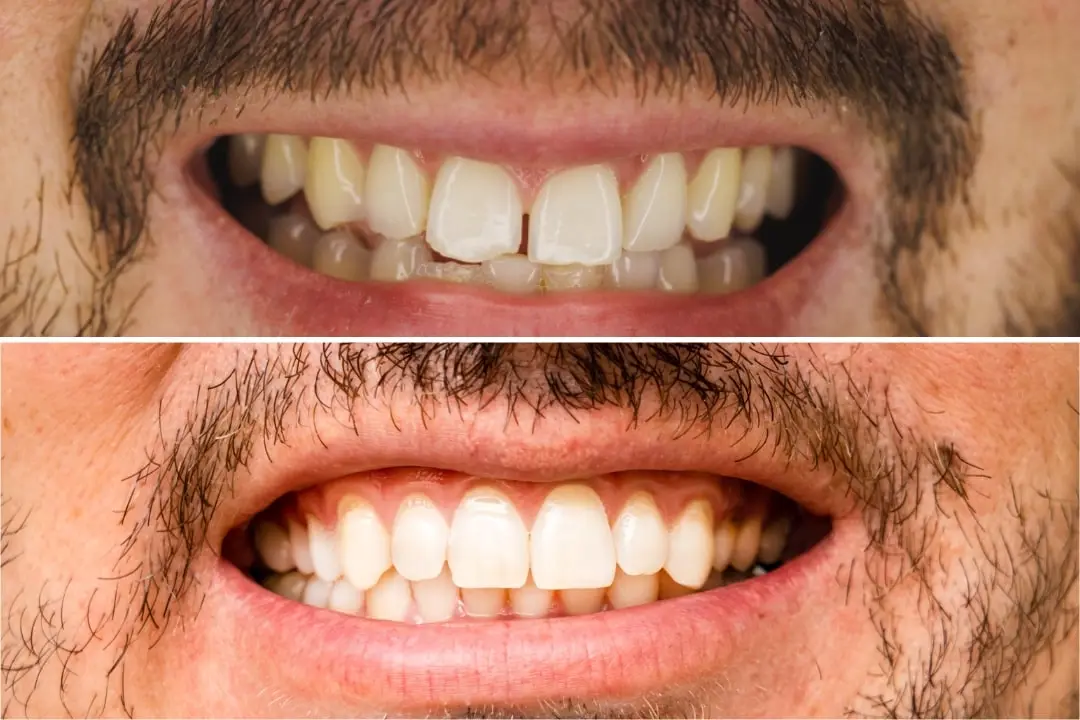 Gappy teeth treatment