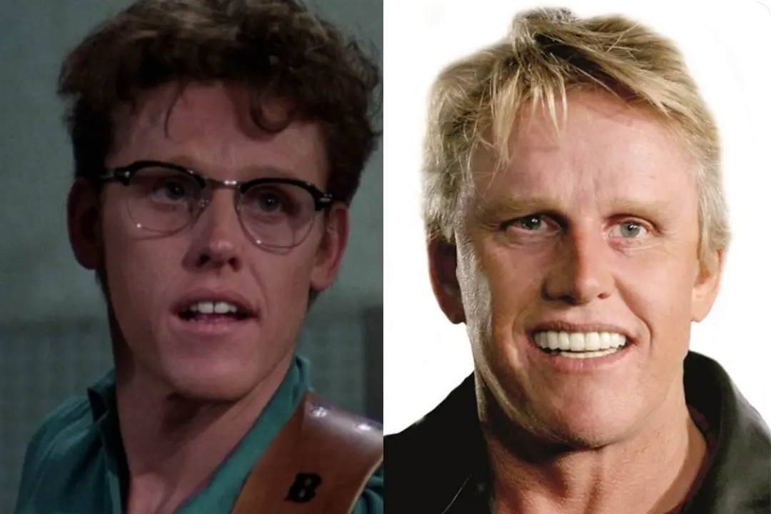 Gary Busey dental implant before after