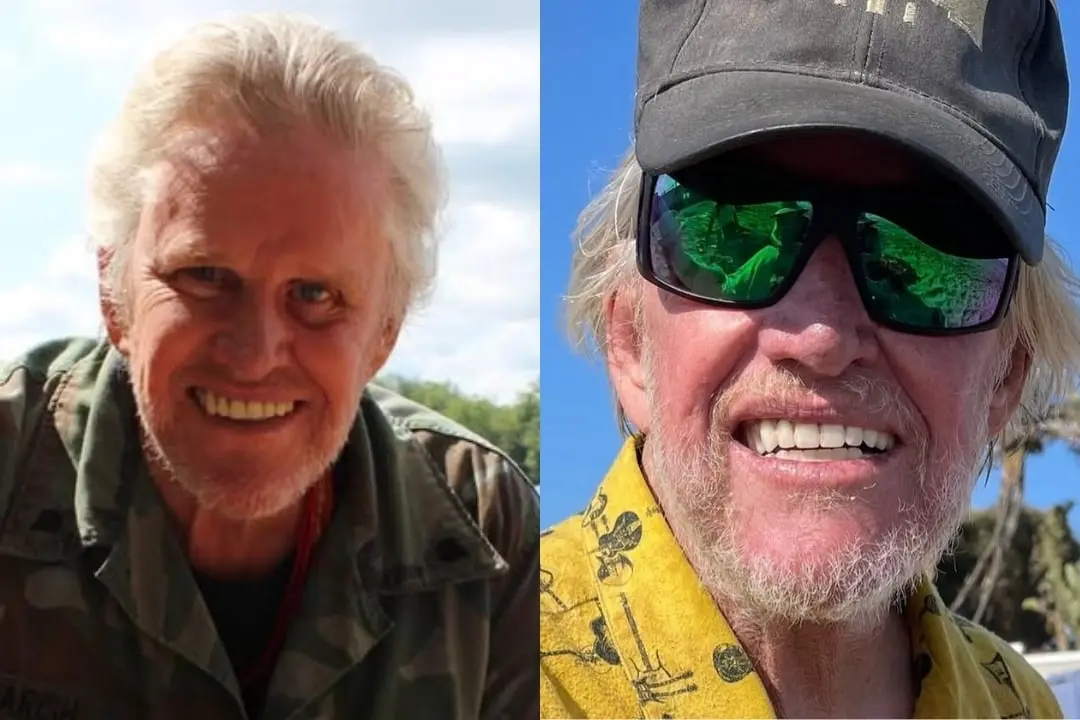 Gary Busey dental implant before after