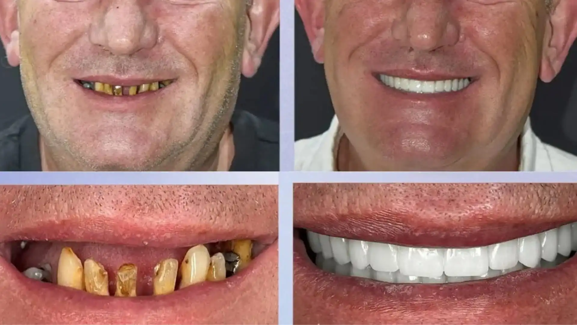 Gum recession treatment in Antalya, at ATK Dentpark