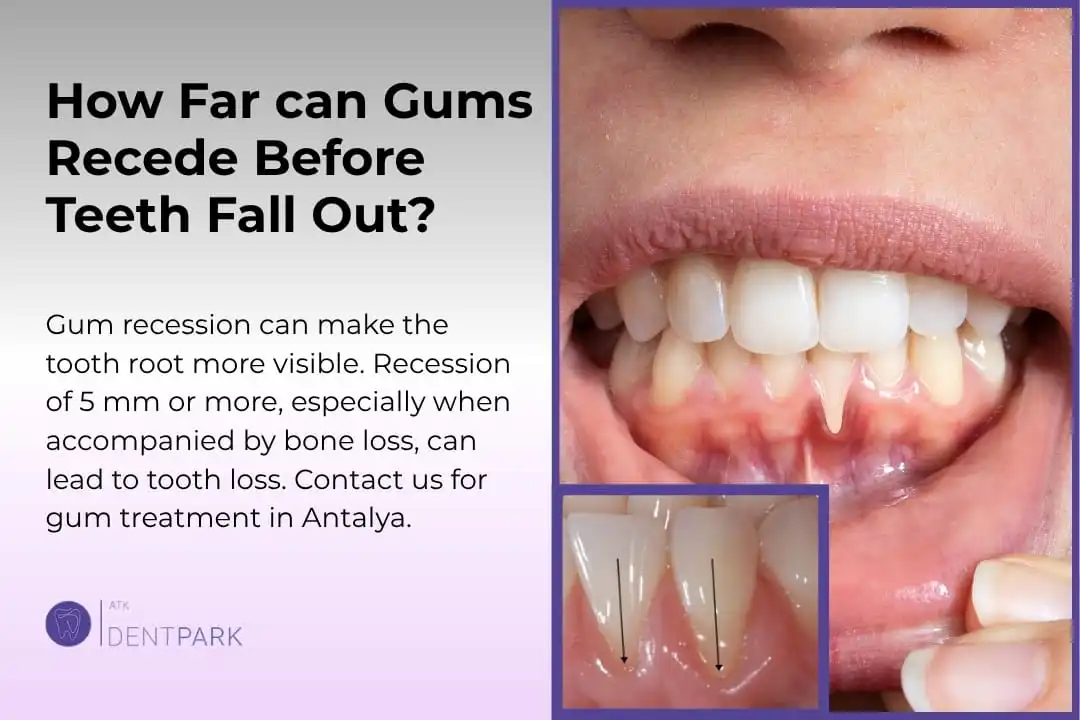 How Far Can Gums Recede Before Teeth Fall Out?