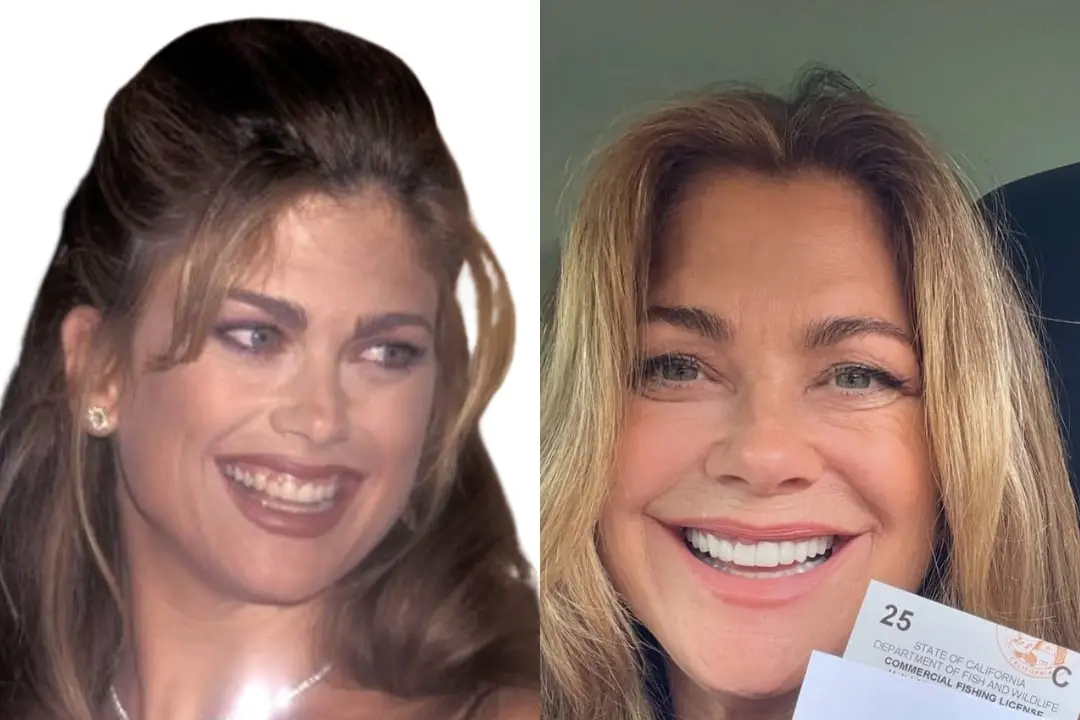 Kathy Ireland dental implant before after