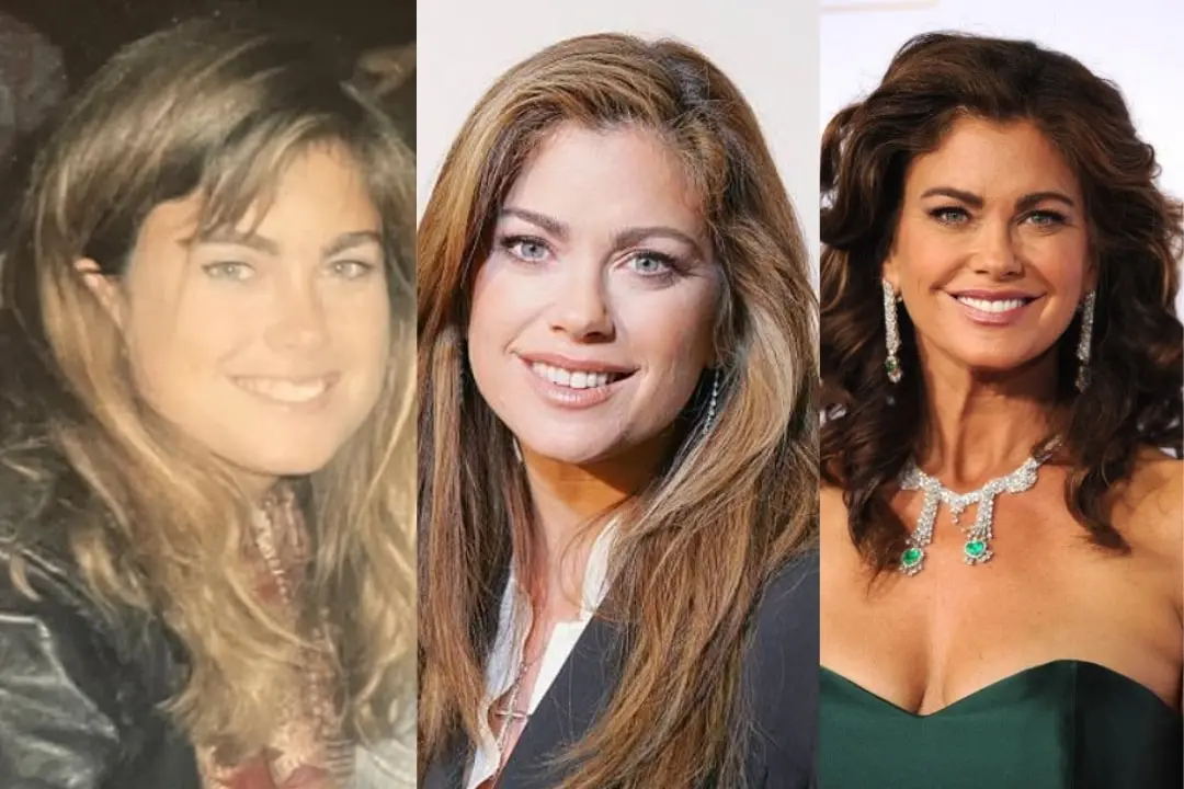 Kathy Ireland dental implant before after