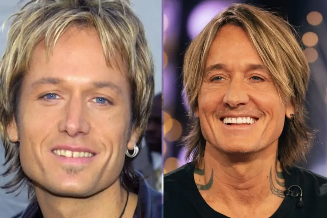 Keith Urban dental implant before after