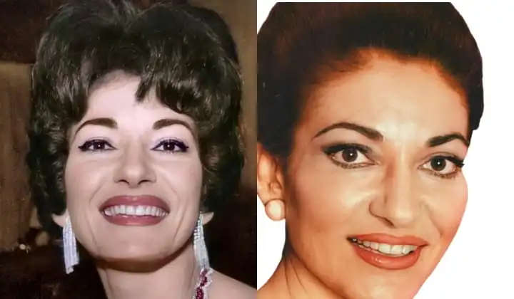 Maria Callas's teeth before and after