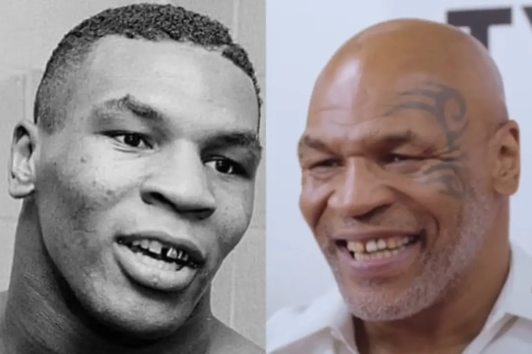 Mike Tyson teeth before after