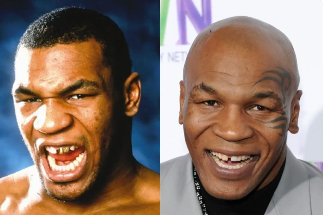 Mike Tyson teeth implant before after