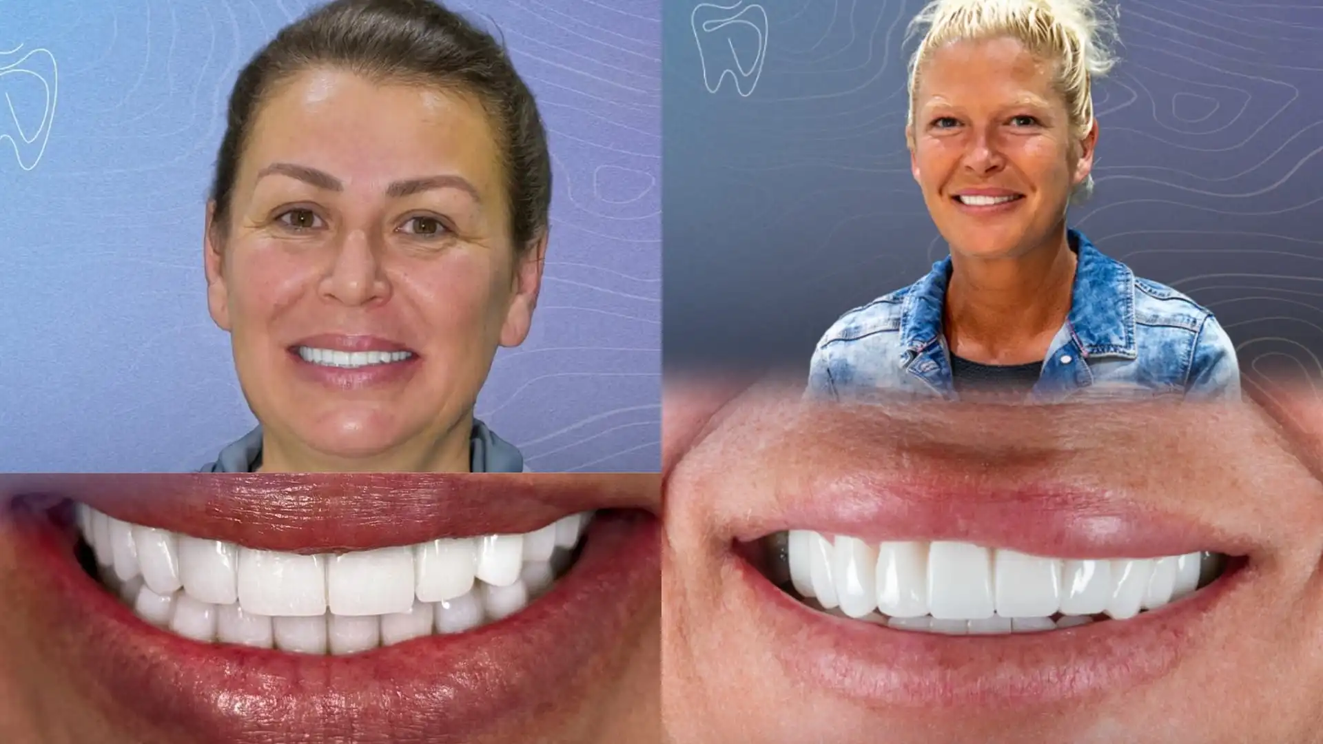 My Crown Fell Off and My Tooth is Black: What to do?