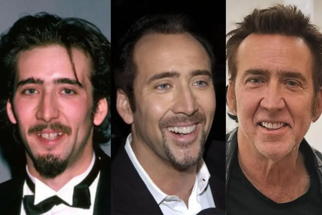 Nicolas Cage dental implant before after
