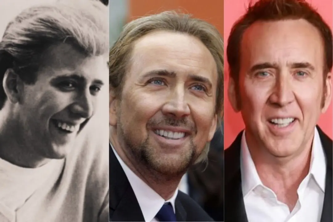 Nicolas Cage dental implant before after