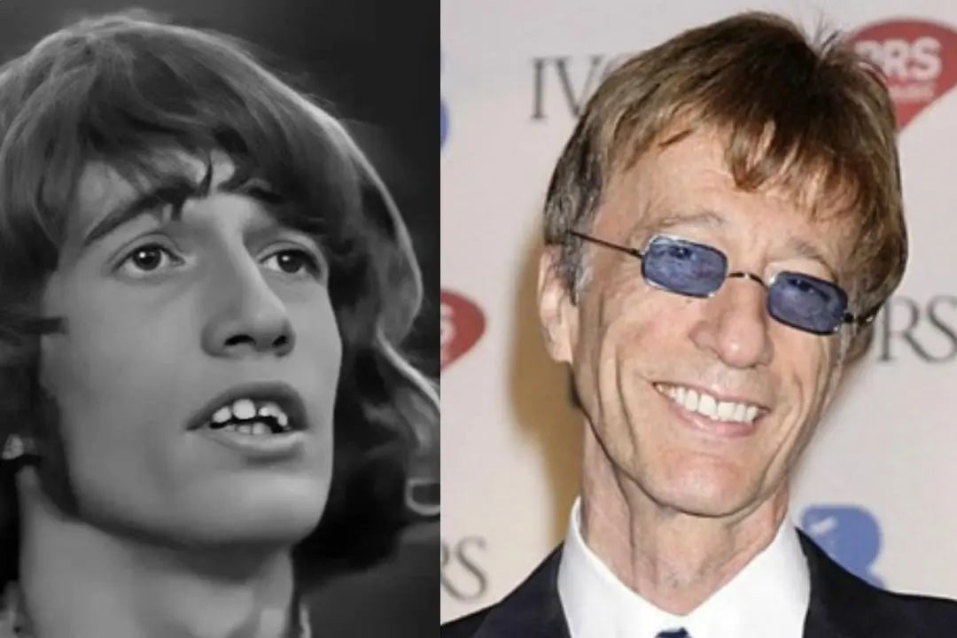 Robert Gibb teeth before after