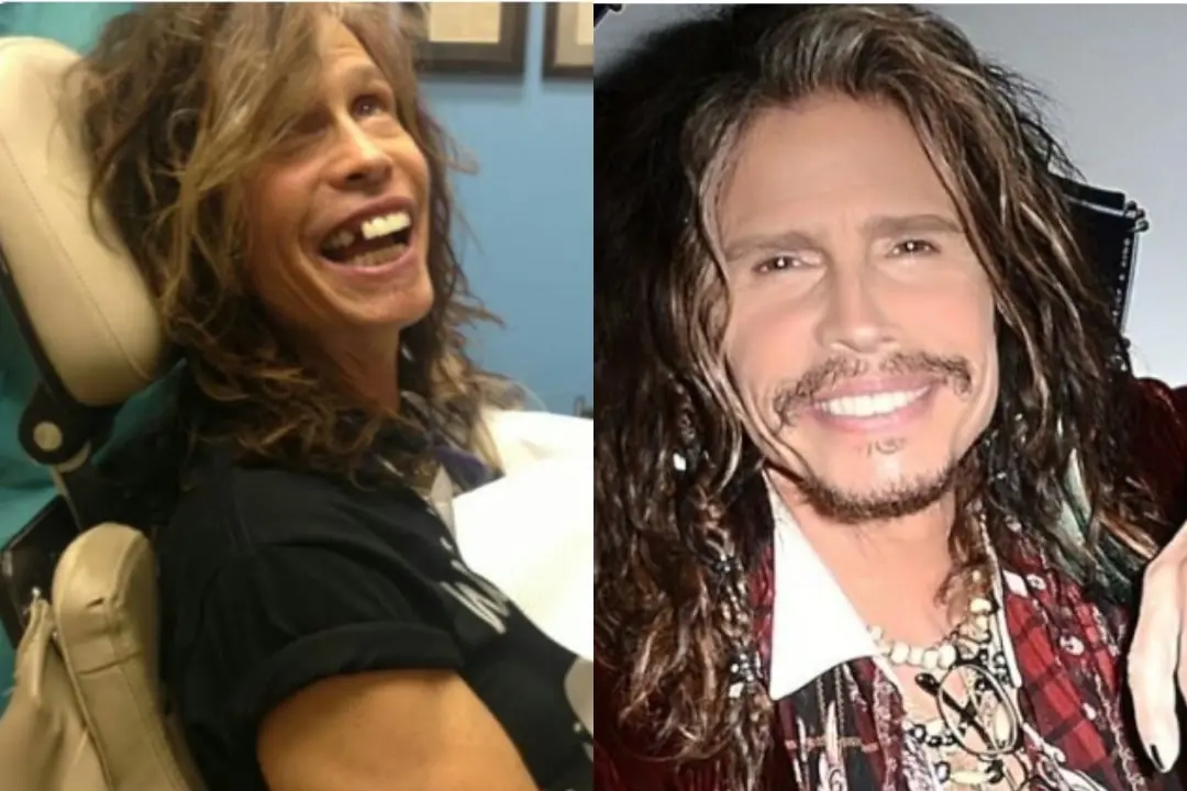 Steven Tyler dental implant before after
